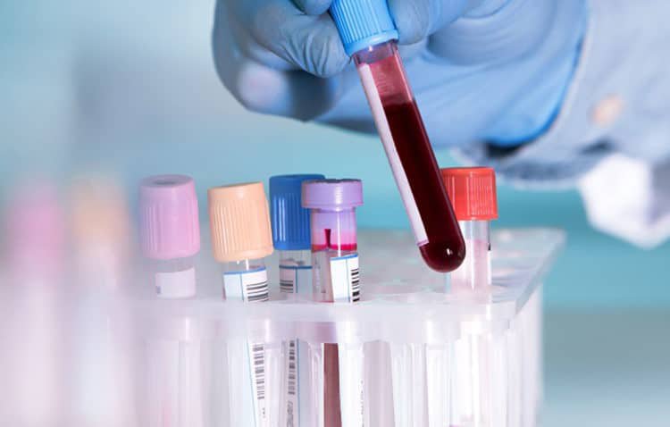 Vì sao cần chủ động xét nghiệm máu tổng quát để phát hiện bệnh? | Vinmec
