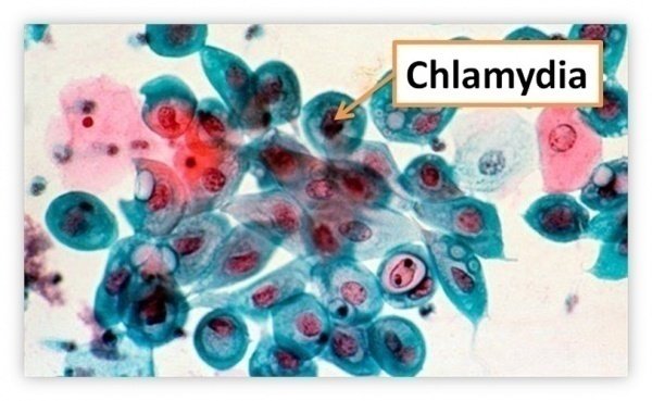 Tìm hiểu về bệnh lây nhiễm qua đường tình dục chlamydia, lậu và giang mai |  Vinmec