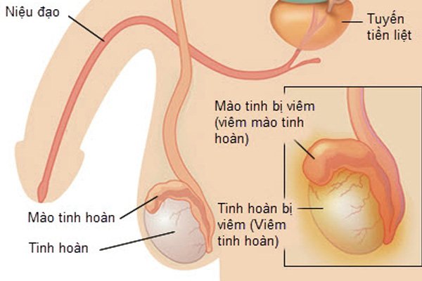 10 lý do gây đau tinh hoàn đáng báo động