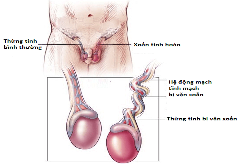 Hiện tượng xoắn tinh hoàn